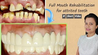 full mouth rehabilitation for attrited teeth | #shorts screenshot 2
