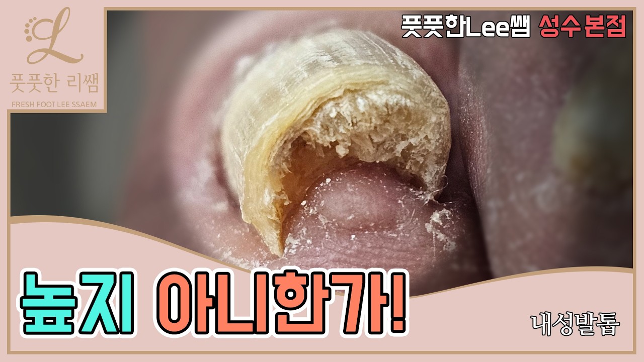 높지 아니한가! 높디 높아진 발톱 갈아내볼까요? ingrown toenail / ingrowing nail - Fresh Foot 풋풋한리쌤 성수본점