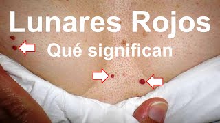 Que Significan los Lunares Rojos by Dr. Salomon (Ni una Dieta más) 72,907 views 2 years ago 3 minutes, 26 seconds