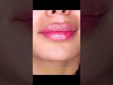 جمال النتيجة النهائية   عيادة تجميل الشارقة  فلر شفايف