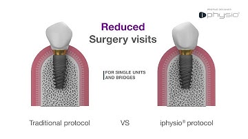 Three in one solution – Iphysio: a game changer in implant protocol?