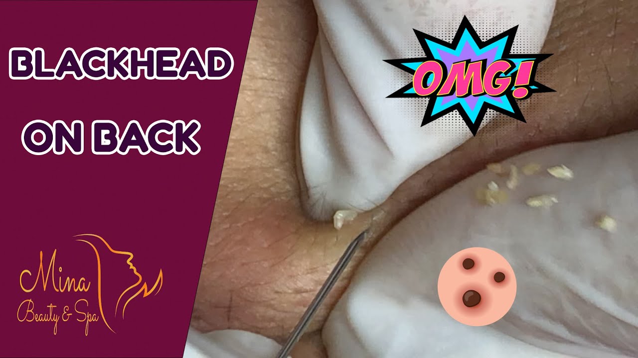 Ga Spa Videos For Removal Of Blackheads