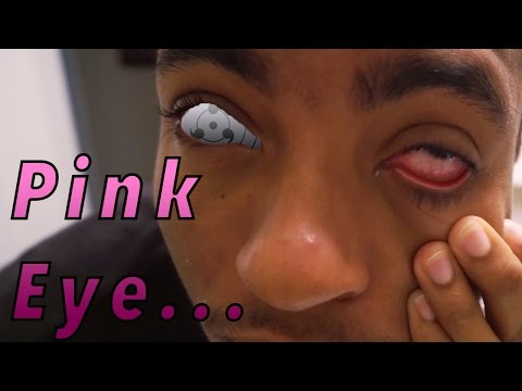 Pink Eye (Conjunctivitis) Apple Cider Vinegar Home Remedy