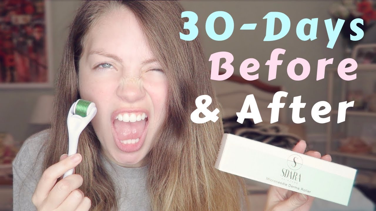 I tried the SDARA DERMA ROLLER for 30 days Micro Needling Before and