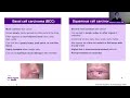 Skin Cancers: Prevention, Screening & Treatment (Melanoma, Basal Cell  & Squamous Cell Carcinomas)