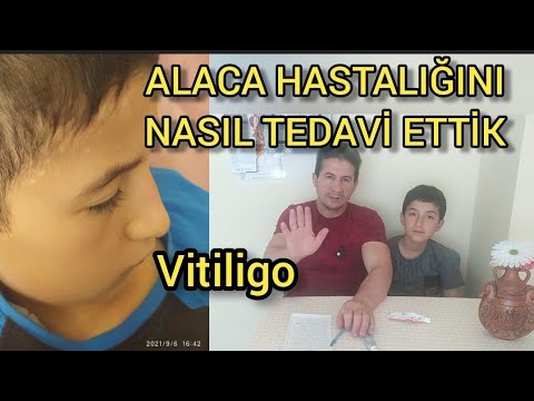 Vitiligo Alaca Hastalığını Nasıl Tedavi Ettiğimizi Anlattım 🤲