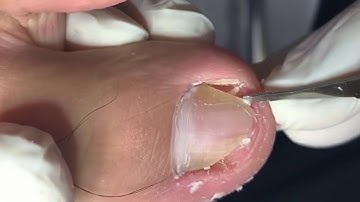 CẮT MÓNG CHÂN ĐÂM VÀO THỊT - LẤY KHÓE MÓNG CHÂN SƯNG ĐAU CỰC PHÊ - XEM XONG HẾT MUỐN ĐI GIÀY P272