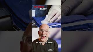 Cement Blocks 🧱 to Treat NASTY Joint Replacement Infections #shorts
