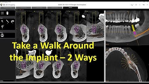 CS 3D Imaging - Take a Walk Around The Implant - 2 Ways