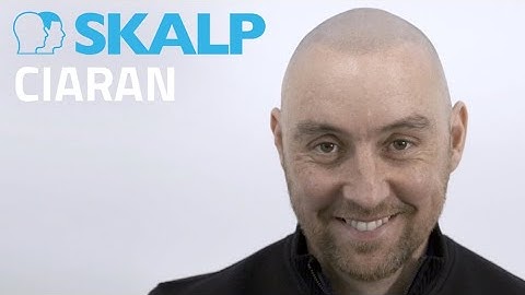 Scalp Micropigmentation by Skalp® Dublin - Ciaran