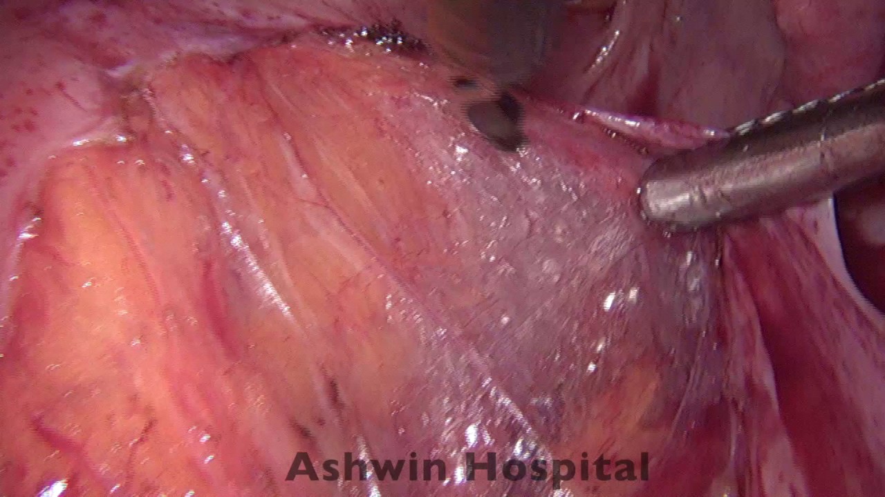 video editing software free Laparoscopic Sacral Colpopexy for vault prolapse