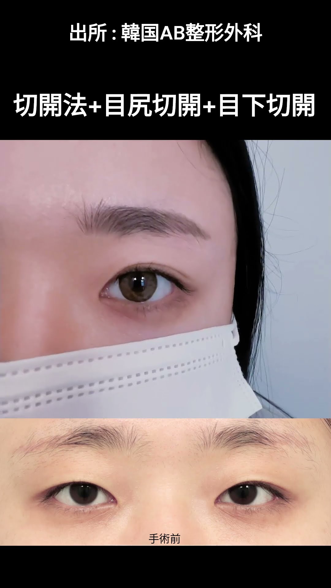 整形前後 '二重+目尻切開+目下切開'