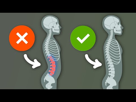 Video: Kann ein Chiropraktiker bei Lordose helfen?