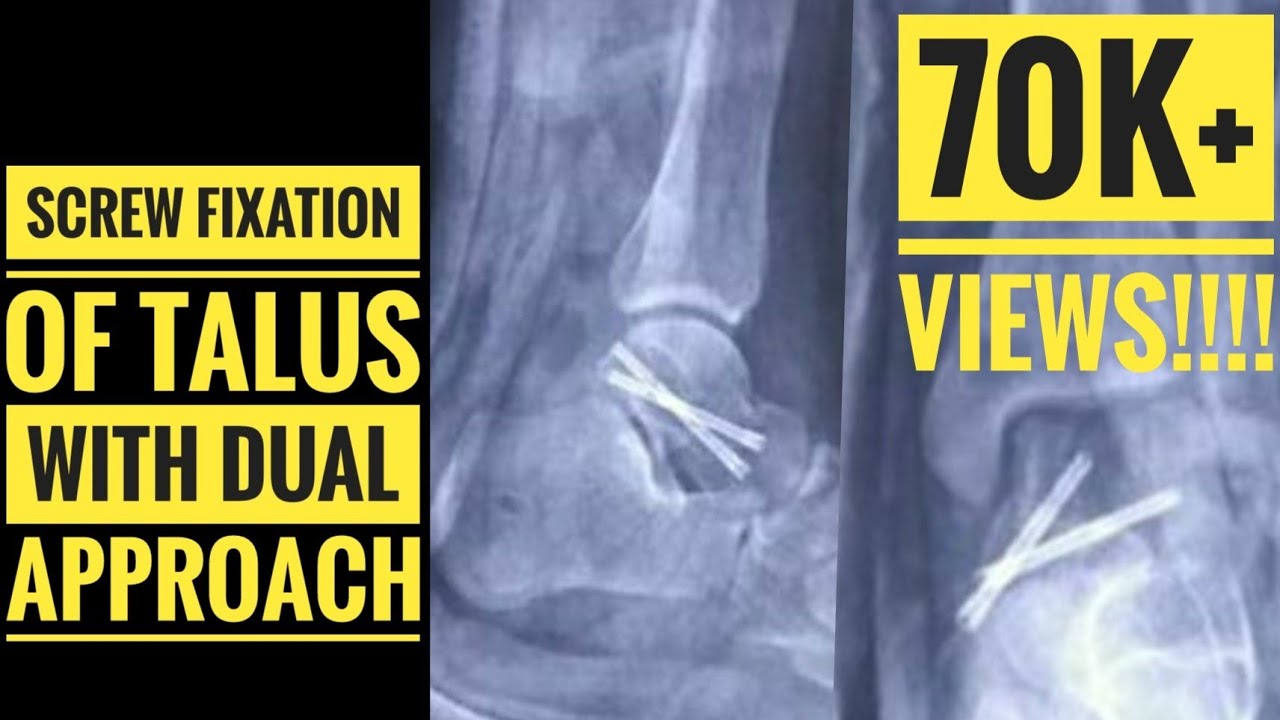 Screw fixation of Talus with Dual Approach (Anterolateral and