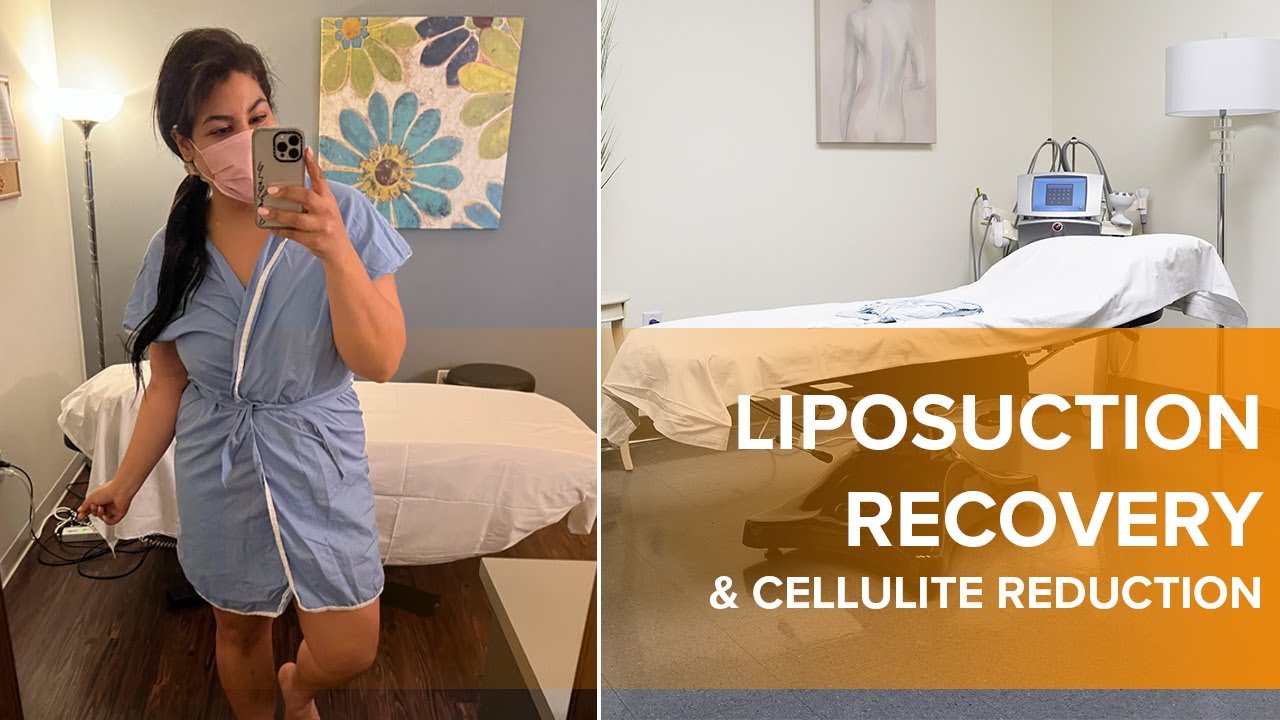 Sono Bello x Venus: Post-Op Liposuction and Tummy Tuck Healing and