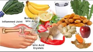 Download യൂറിക് ആസിഡ് എളുപ്പത്തിൽ നിയന്ത്രിക്കാം Uric Acid Treatment Latest Malayalam Video MP3 യൂറിക് ആസിഡ് എളുപ്പത്തിൽ നിയന്ത്രിക്കാം Uric Acid Treatment Latest Malayalam