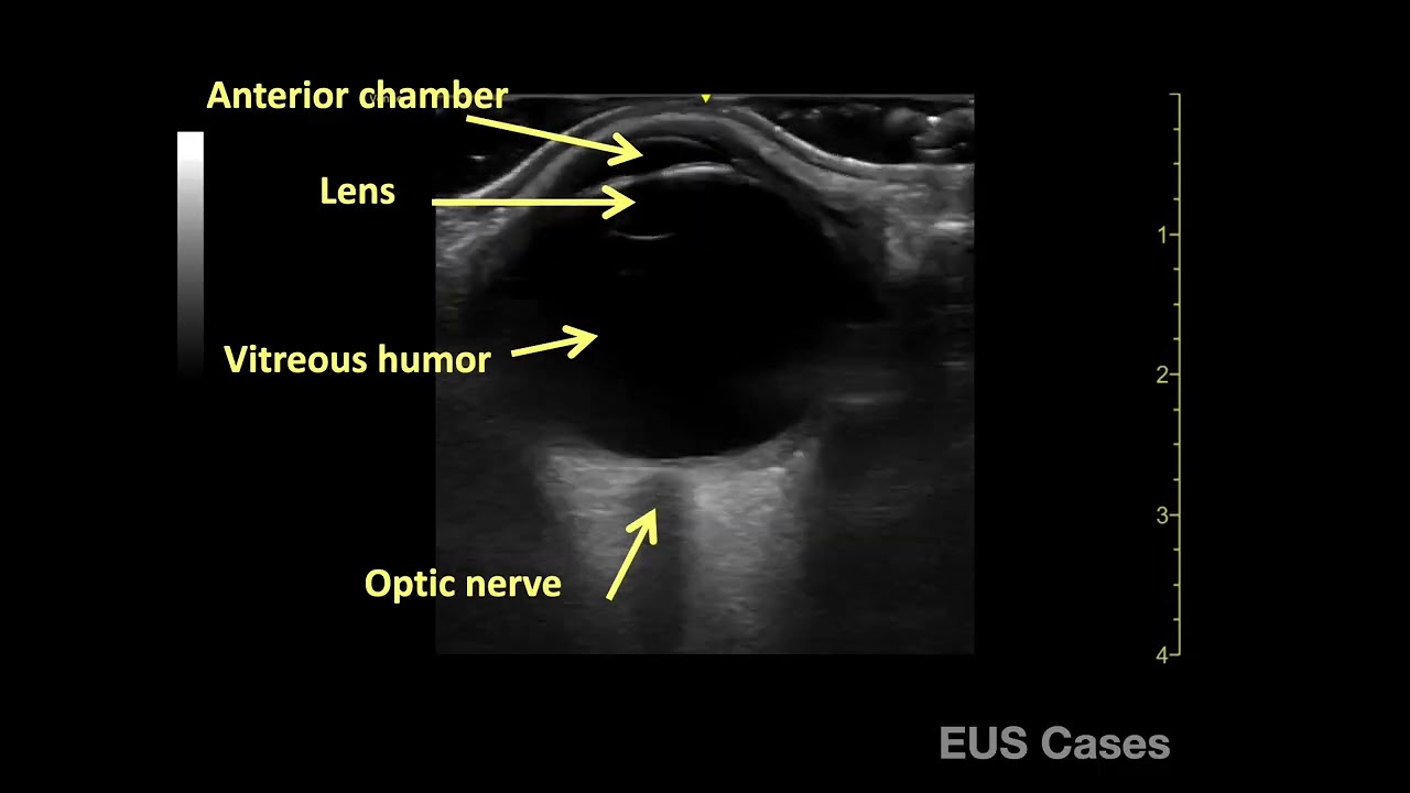 Optic Nerve Sheath Diameter Ultrasound for increased ICP