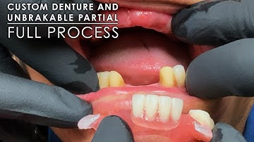 The Full Process of a Custom Denture and Unbreakable Partial