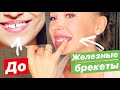 9 ВАЖНЫХ ВОПРОСОВ про БРЕКЕТЫ | СТАВЛЮ ТРЕТИЙ РАЗ! почему не элайнеры? | какая ЦЕНА?