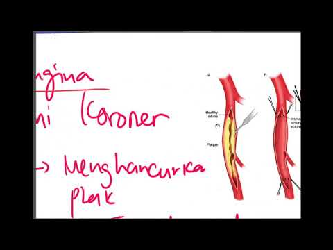 Patofisiologi Angina Pectoris | Pathway Angina Pectoris