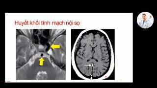 Các chuỗi xung MRI sọ não cơ bản | Ts. Bs. Phạm Thái Hưng