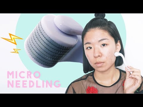 ✂ How To Heal Acne Scars with Microneedling - Before & After