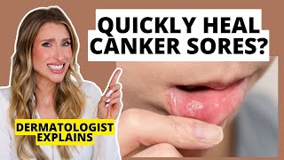 Quickly Heal Canker Sores: How to Prevent & Heal Them Faster | Dermatologist Explains screenshot 4