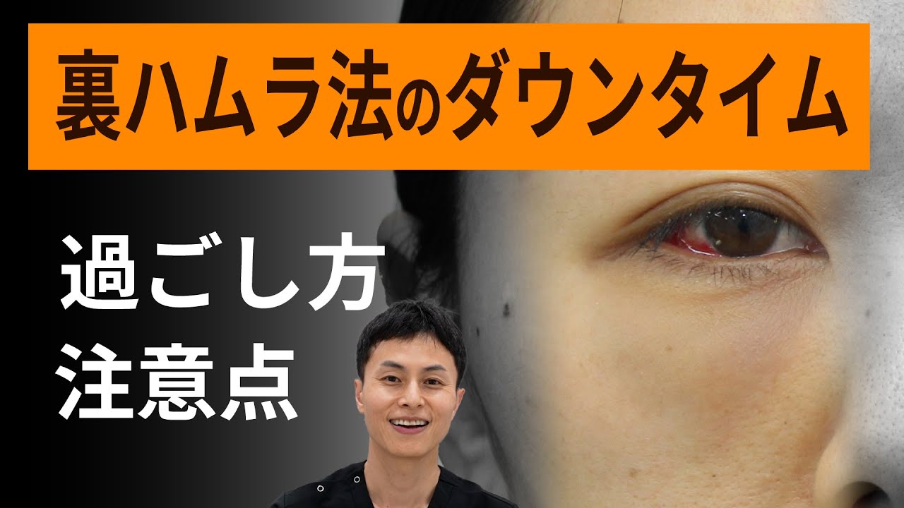 裏ハムラ法のダウンタイムの過ごし方、注意点、腫れ、内出血、仕事復帰、入浴、運動、喫煙などについて
