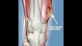 Reiki Angel Number for Sarcoma of soft Tissue (नरम ऊतक का सरकोमा) screenshot 1