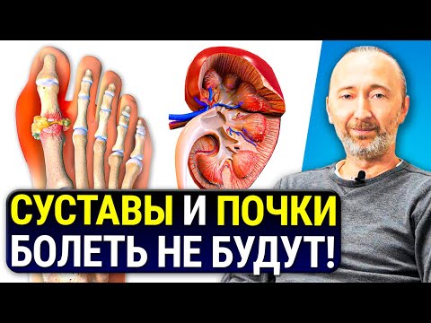 Как вывести МОЧЕВУЮ КИСЛОТУ? Лечение Подагры и Почек натуральными мерами!