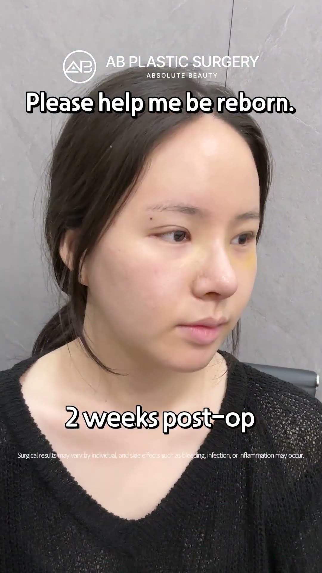 5 Months Post-Op: My New Life After Eye & Nose Surgery✨ #shorts