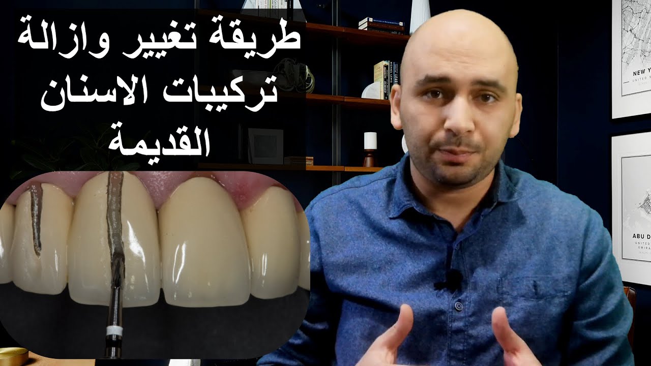 تغيير تركيبات الاسنان الثابتة وطريقة ازالة تركيبات الاسنان الزيركون والبورسلين والايماكس