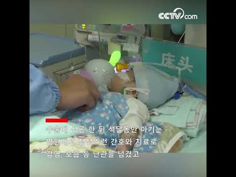 66일 아기 심장 <strong>교체</strong> 수술 <strong>성공</strong>  | CCTV 한국어방송