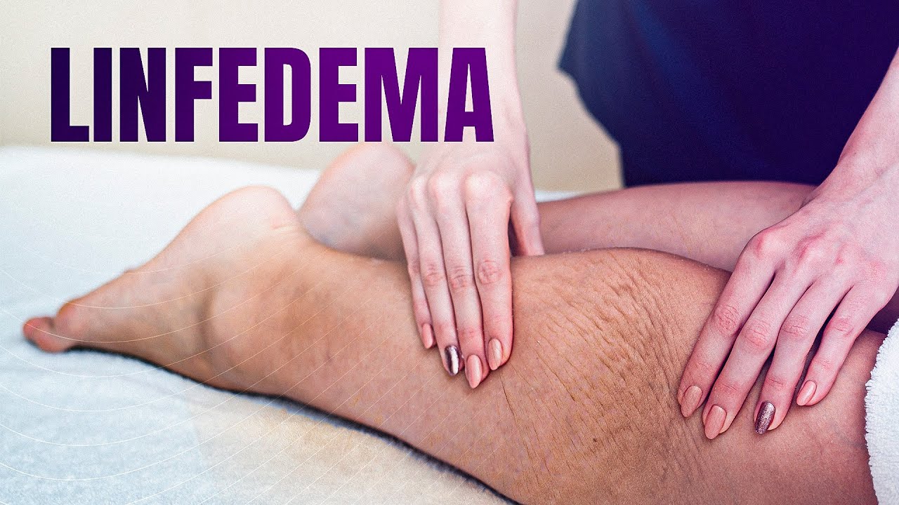 Como Reduzir o Linfedema Apenas com suas Mãos