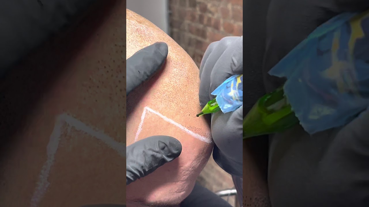Watch how Scalp-Micropigmentation SMP is Applied on a Hairline