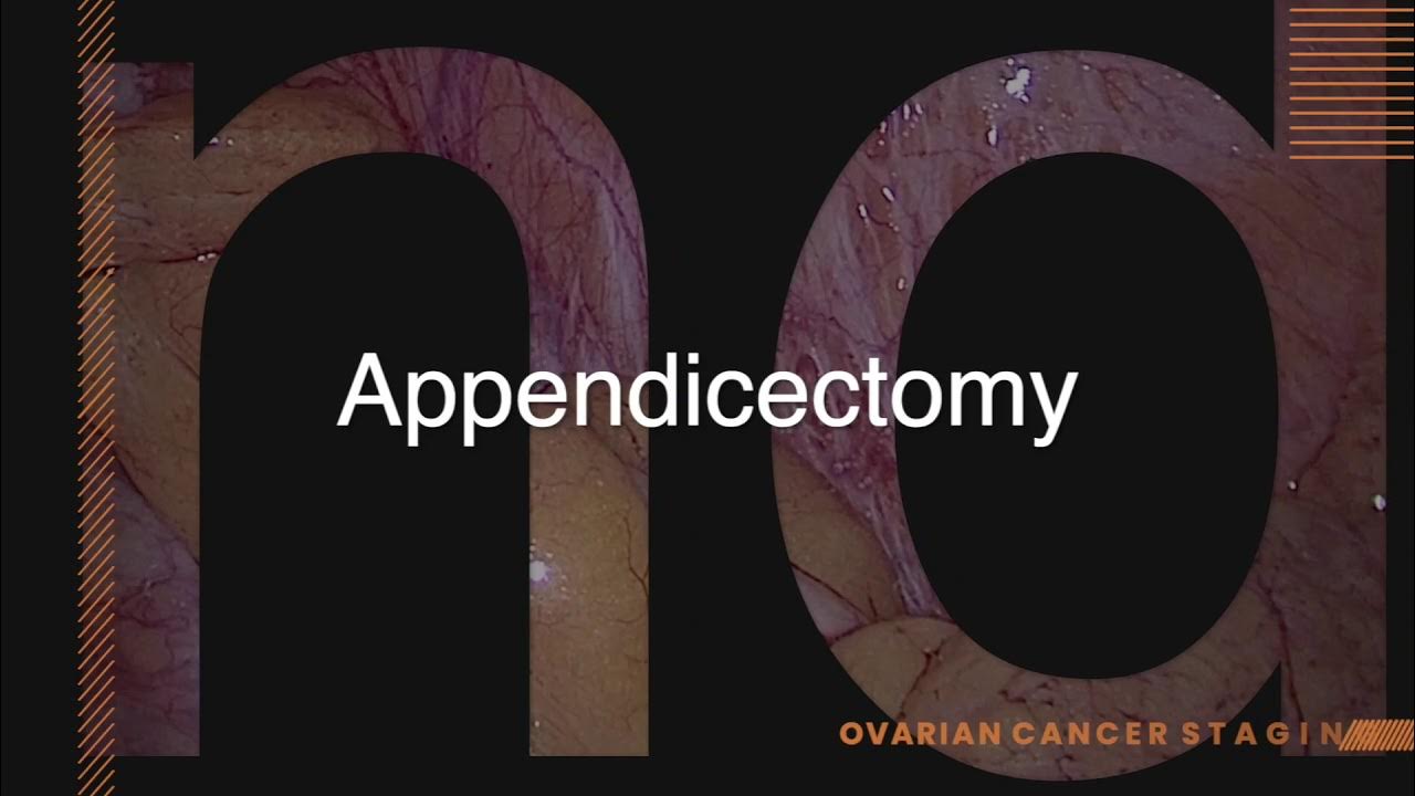 Ovarian cancer Laparoscopic Infracolic omentectomy, appendectomy and