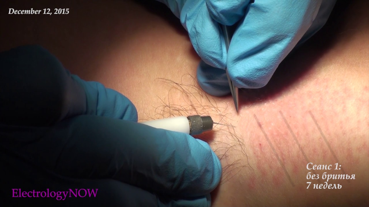 ЧАСТЬ 1: Удаление волос на подмышках