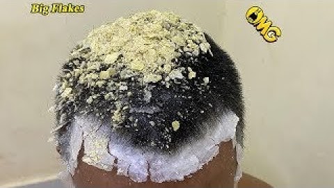 Huge Flake Removing #BigFlakeRemove #Dandruffscratching  #Dandruff #Scratching