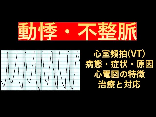 心室頻拍のすべて sddefault.jpg