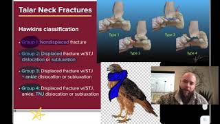 Hawkins Classification of Talar Neck Fractures