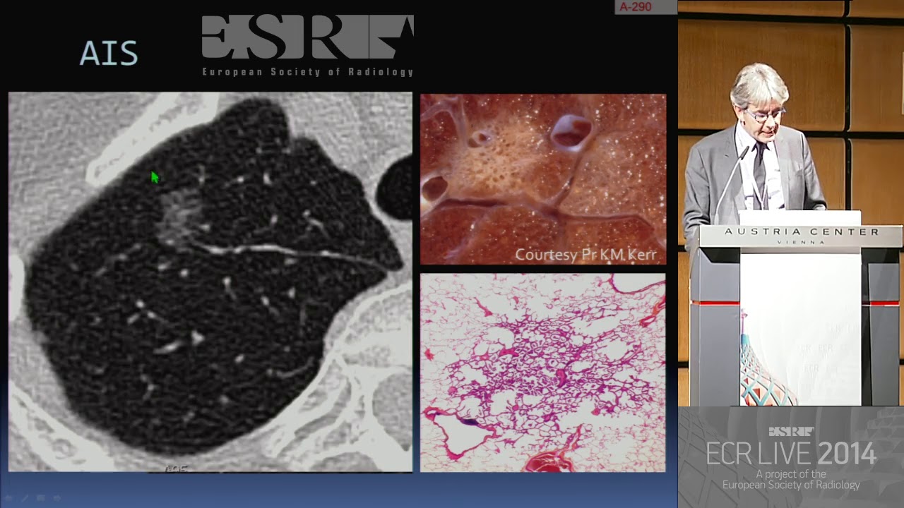 Chest - Patterns in chest radiology   Are there subtype patterns of ground glass opacity GGO
