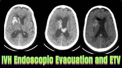 Endoscopic IVH Evacuation & ETV & EVD | Right Caudate Bleed – Neurosurgical Emergency