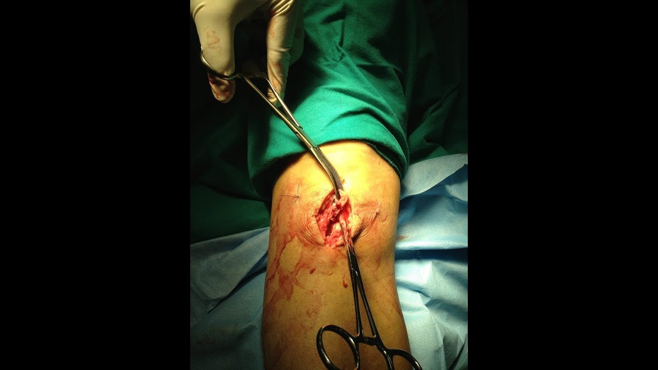 Medial meniscus posterior horn R knee Arthroscopy 31/10/2017 - YouTube