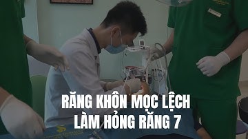 🛑 TRỰC TIẾP: NHỔ RĂNG KHÔN CHÈN ÉP GÂY HỎNG RĂNG SỐ 7