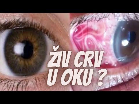 Indijcu iz Oka Izvukli Živog Crva od 7cm