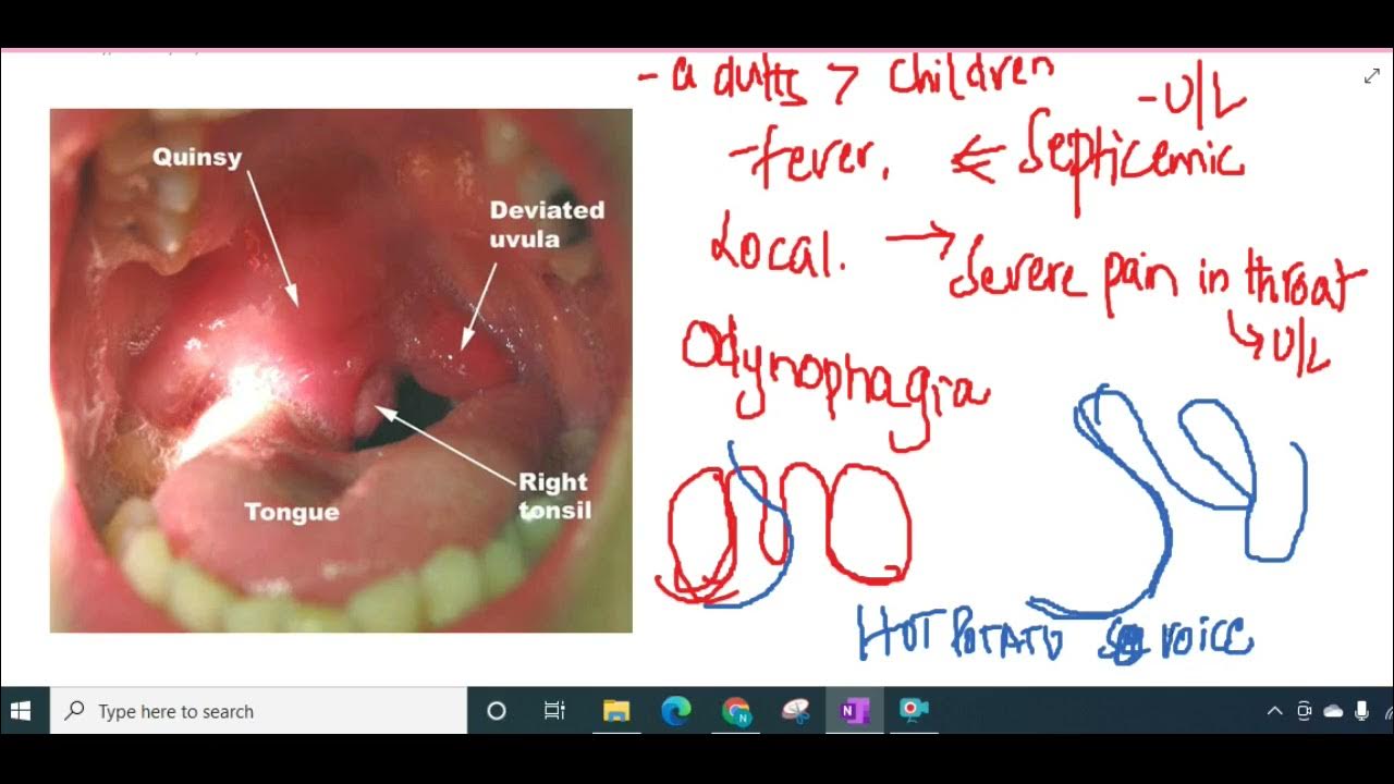 quinsy ENT YouTube