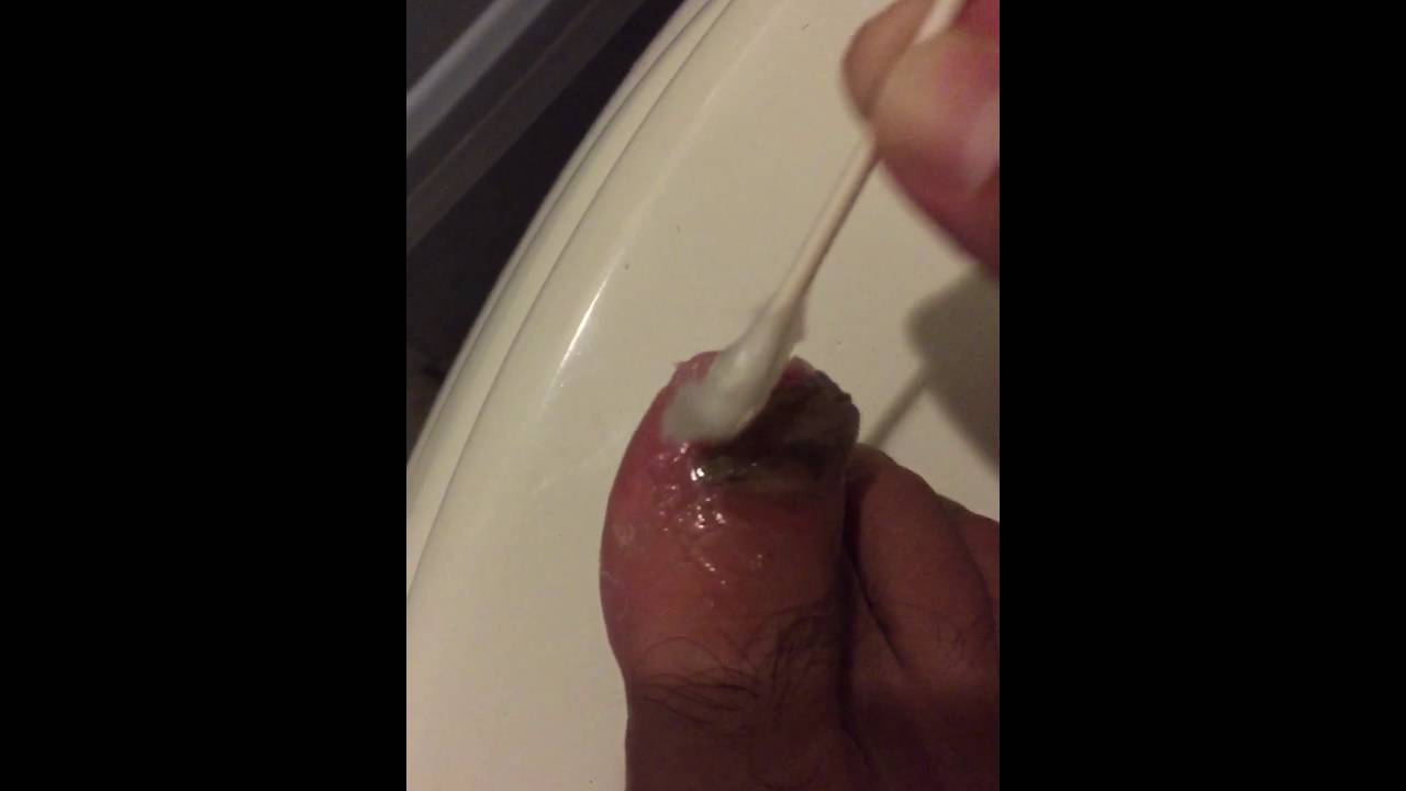 Treat toe nail fungus with Vicks vapor rub - YouTube