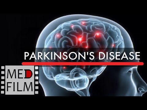Parkinson&rsquo;s disease akinetic-rigid syndrome, academician L.O.Badalyan ©