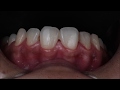CLASS III COMPOSITE STEP BY STEP