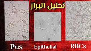 microscopical exam (Pus-RBCs-Epith)